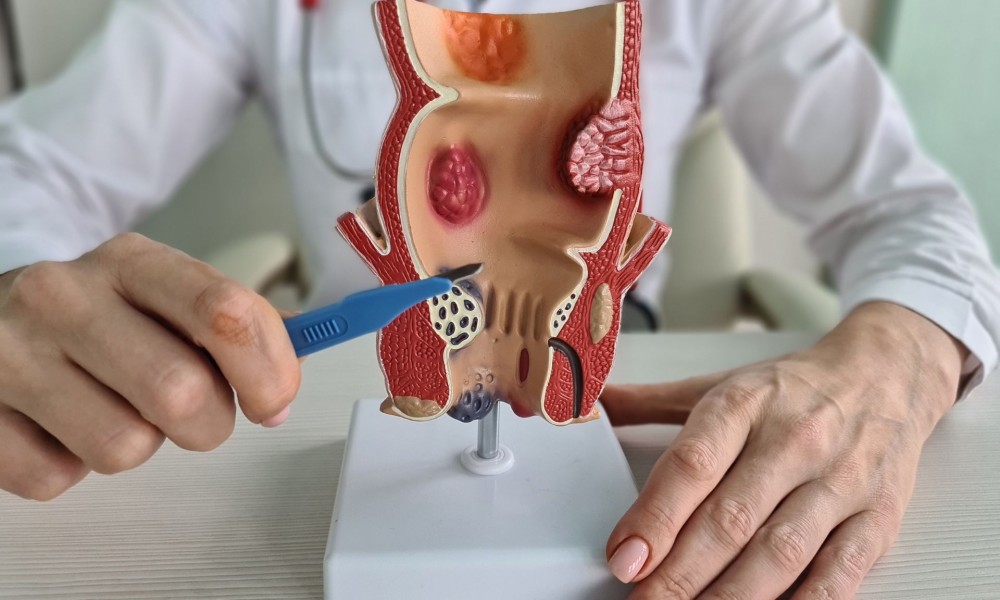 Adapazarı'nda Makat Çatlağı Tedavisi