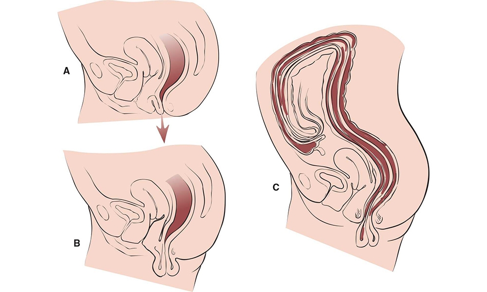 Makat Sarkması (Rektal Prolapsus)